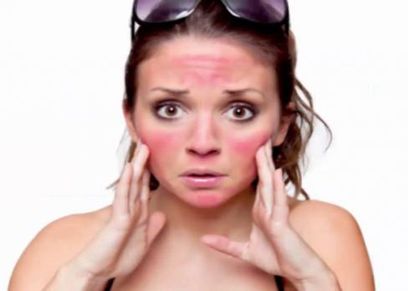 أحمرار الجلد والحكة من أبرز أعراض حساسية الشمس