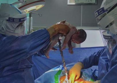 ولادة طفل من أم مصابة بكورونا
