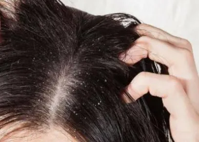 طبيب يوضح طرق التخلص من قشرة الشعر في الشتاء