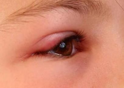 أسباب تورم العين عند الأطفال