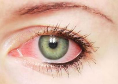 التهاب القزحية قد يعرضك لفقدان البصر