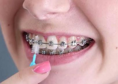 أستاذ تجميل أسنان ناصحا يجب الحفاظ على نظافة الاسنان أثناء التقويم