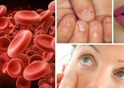 أعراض فقر الدم