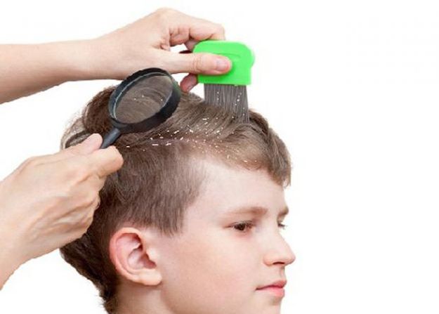 علاج قشرة شعر الطفل