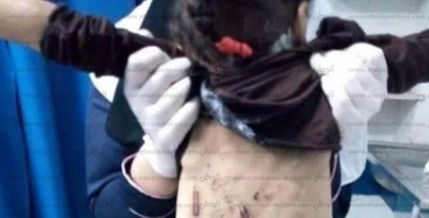 أثار التعذيب على جسد الطفلة جنة محمد