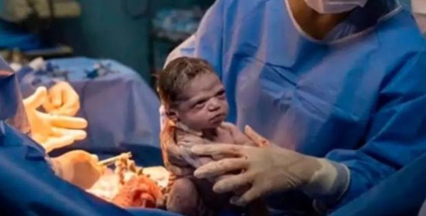 الطفلة البازيلية الغاضبة عقب ولادتها مباشرًا