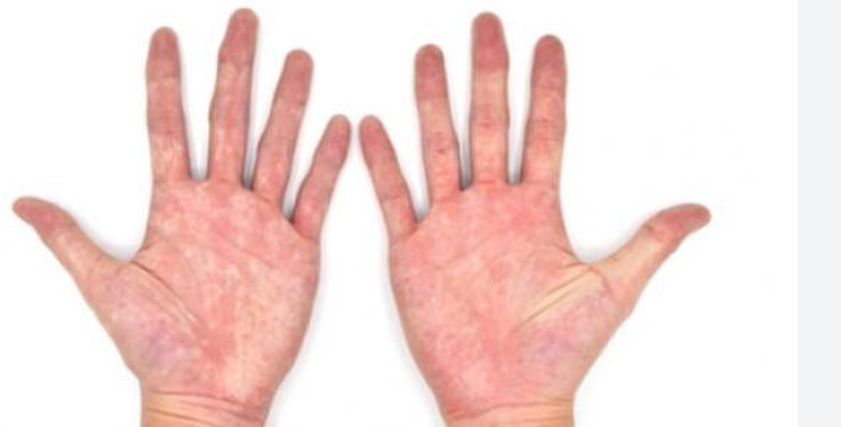 علامات تظهر على اليدين تشير للاصابة بأمراض خطيرة