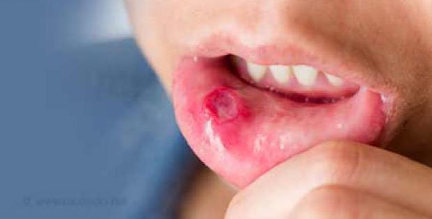 علاج قرح الفم - تعبيرية