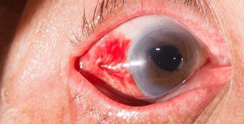 أعراض جلطة العين وطرق العلاج