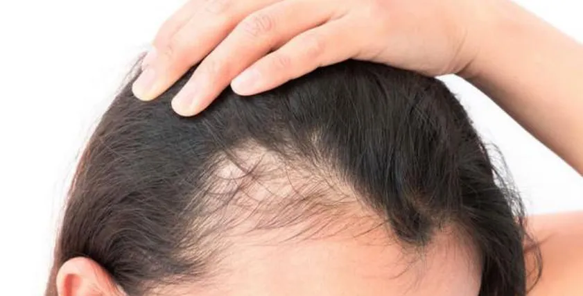 علاج تساقط الشعر 