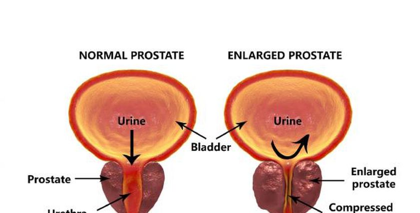 مرض البروستاتا