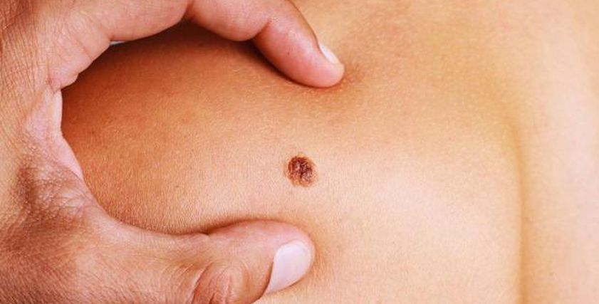 طبيب يوضح العلامات التي تدل على الإصابة بسرطان الجلد