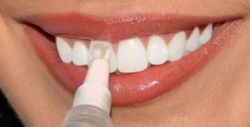 طبيب أسنان يوضح  أهم حالات التجميل الخاطىء للأسنان