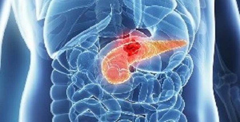 علماء يكتشفون طريقة فعالة لعلاج سرطان البنكرياس