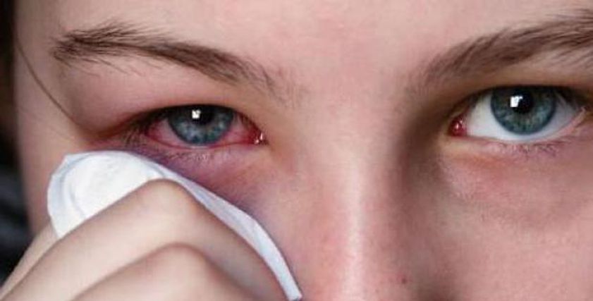 أسباب الإصابة بإفرازات العيون
