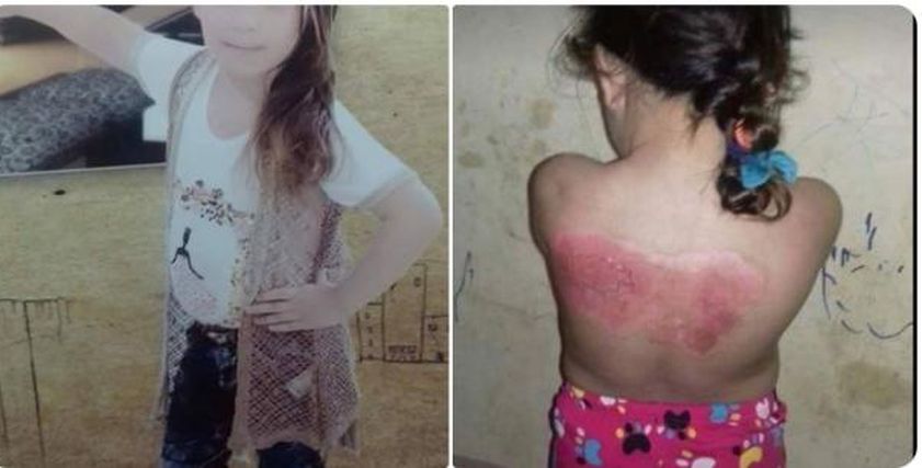 طفلة 5 سنوات تصاب بحروق في جسمها .. ووالدها: نفسي اعالج بنتي