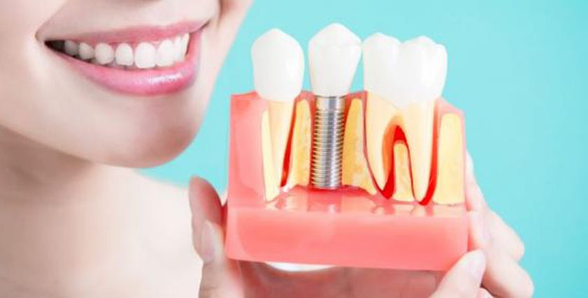 جراح تجميل الأسنان يوضح سهولة عملية زرع الضروس بدلا من بردها