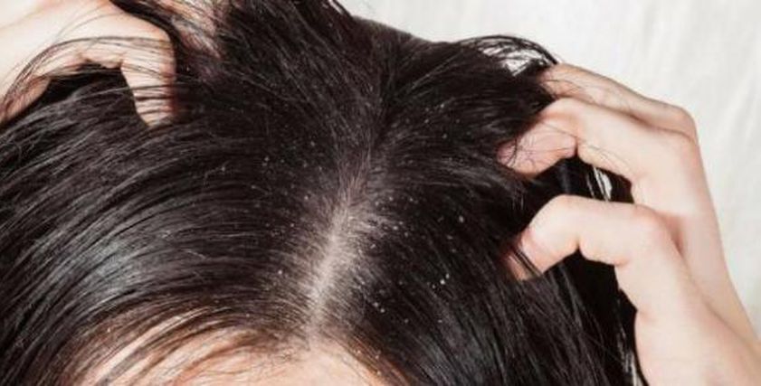 طبيب يوضح طرق التخلص من قشرة الشعر في الشتاء
