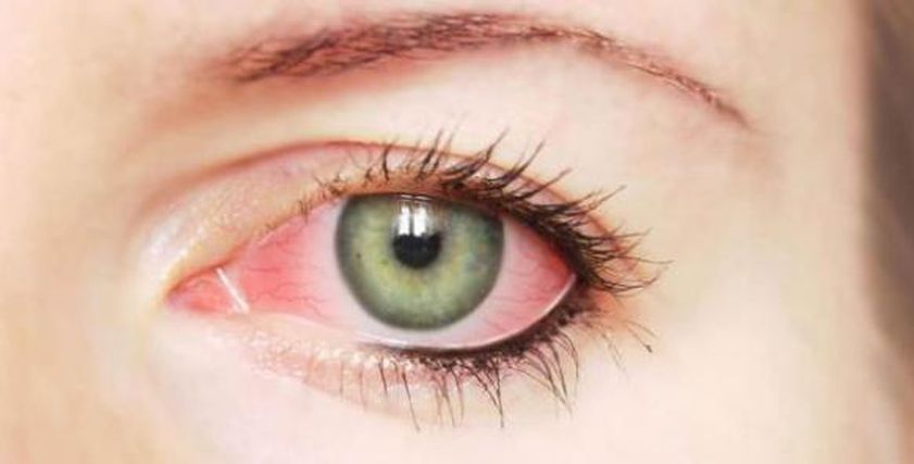 التهاب القزحية قد يعرضك لفقدان البصر