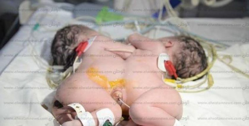 بالصور| بعد ولادة طفل برأسين في أسوان.. أغرب حالات الولادة في مصر