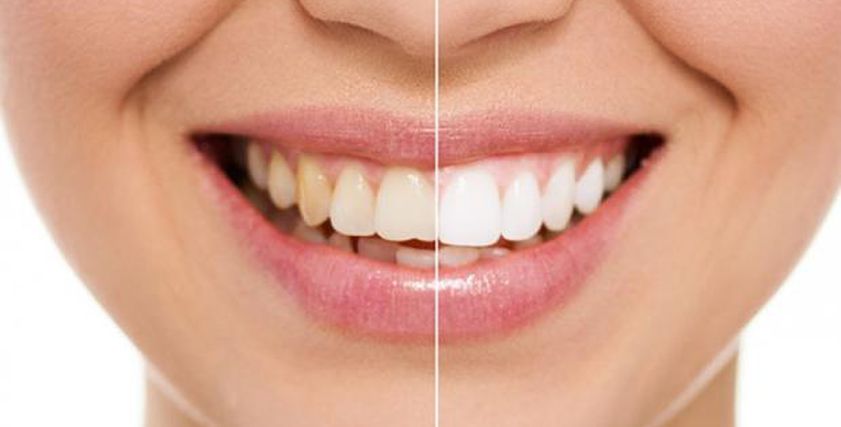 كيفية التخلص من اصفرار الاسنان بالطرق الطبيعية