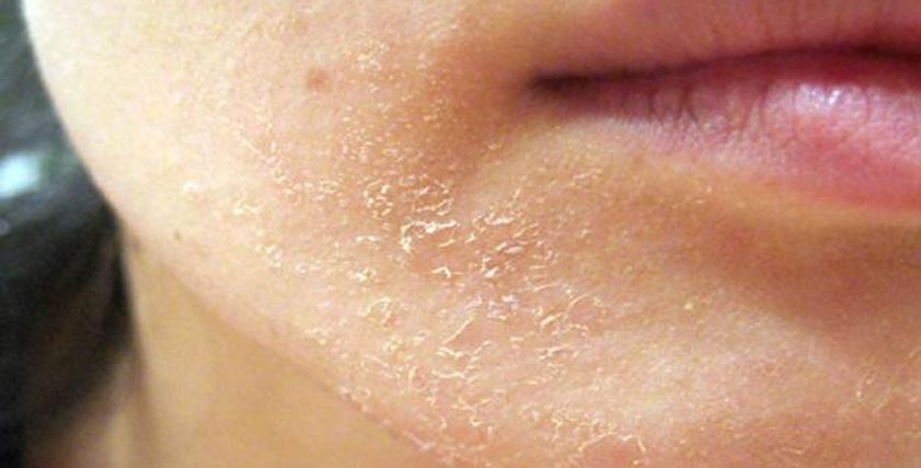 نصائح لحماية الجلد من الجفاف