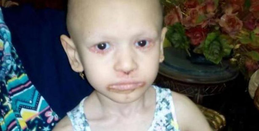 طفلة 4 سنوات تعاني من مرض جلدي نادر يؤدي إلى تساقط جلدها