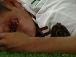 إصابة مرعبة لـ هرفينج لوزانو لاعب المكسيك في الكأس الذهبية «فيديو»