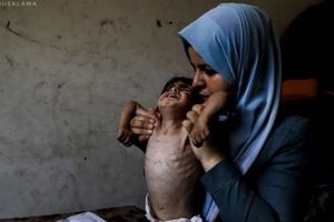 طفل فلسطيني يعاني من سوء التغذية