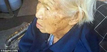حالة طبية نادرة- امرأة صينية تبلغ من العمر 87 عاما لديها قرن فوق رأسها