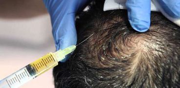 البلازما احدث علاج لتساقط الشعر