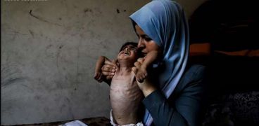 طفل فلسطيني يعاني من سوء التغذية
