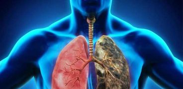 الفرق بين رئة المدخن والرئة السليمة