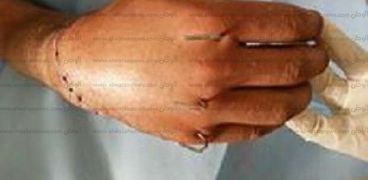فريق طبى بمستشفى الأزهر الجامعى بدمياط يجرى جراحة نادرة لإعادة زراعة يد مبتورة