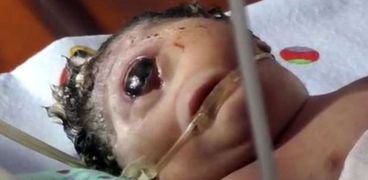 ولادة طفلة إندونيسية ضخمة ذات عين واحدة