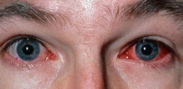 فيروس العين الوردية