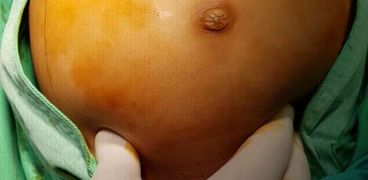 بطن الطفل قبل اجراء العملية وإستصئال الورم