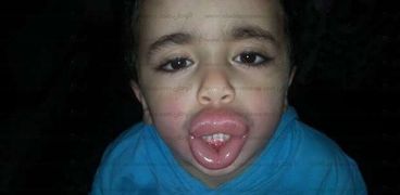 الطفل المُصاب بتورم بسبب كيش مقرمشات فى كفر الشيخ