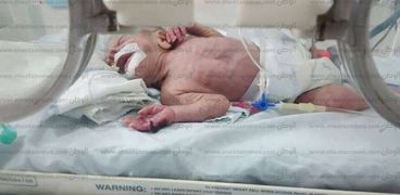 الطفل المصاب بحرق في يده  نتيجة خطأ بمستشفى بركة السبع