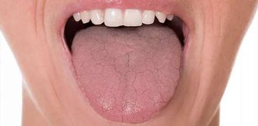 جفاف الفم - تعبيرية