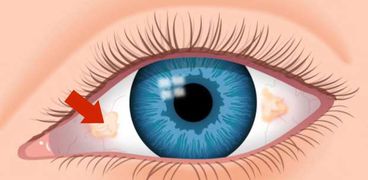 دراسة تحذر: ظهور بقع صفراء في العينين مؤشر مبكر على الخرف والزهايمر