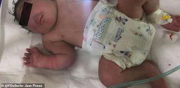 ولادة طفل بدون أنف في العراق
