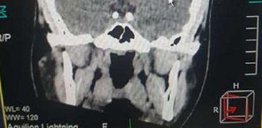 صورة الأشعة الخاصة برأس الطفل