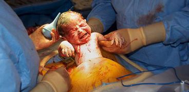جراحة الولادة القيصرية