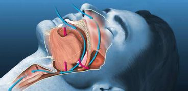 أعراض الإنسداد التنفسي أثناء النوم