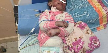ياسمين محمد، الطفلى التى تعرضت للحروق