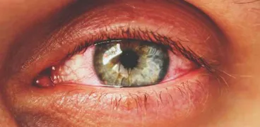 باحثون يطوّرون قطرات للعين قد تمنع فقدان البصر