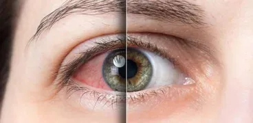 جفاف العيون - صورة تعبيرية