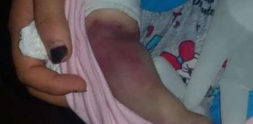 خطأ طبي بمستشفى تلا العام  يتسبب في بتر ذراع طفلة رضيعة