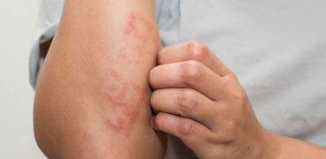 أمراض جلدية تظهر في فصل الصيف